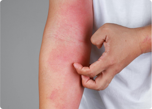 Rashes treatment in Edmonton