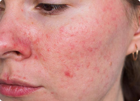 Rosacea treatment in Edmonton