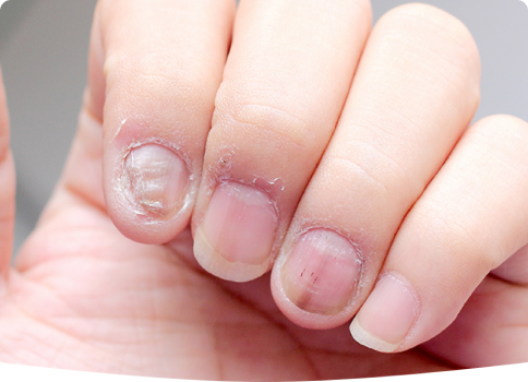 Nail fungus treatment in Edmonton