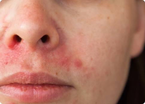 Peri-oral dermatitis treatment in Edmonton