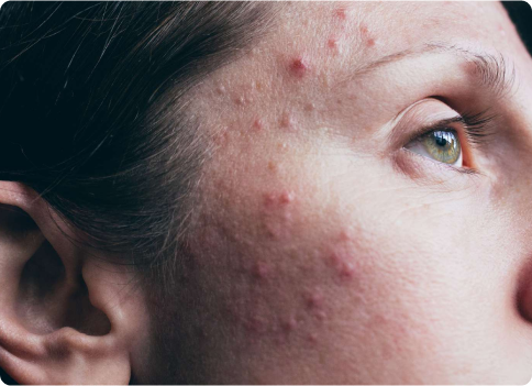 Acne treatment in Alberta