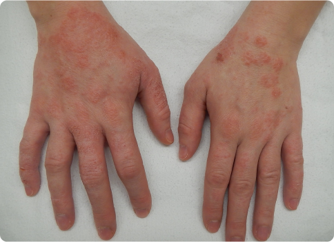 Eczema treatment in Alberta