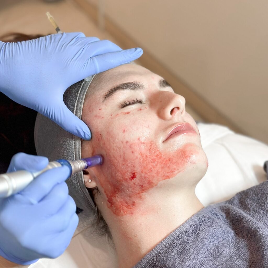 PRP Treatment in Edmonton